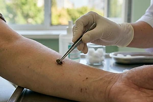 В Кызылжарском районе СКО выявлен случай клещевого энцефалита